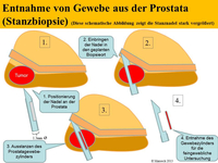 Stanzbiopsie der Prostata