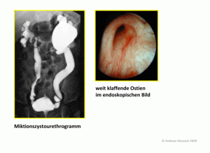 mcu-und-cystoskopie-bei-vesikorenalem-reflux-0b