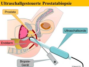 Stanzbiopsie der Prostata