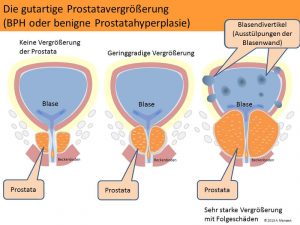 prostatavergroesserung-b1
