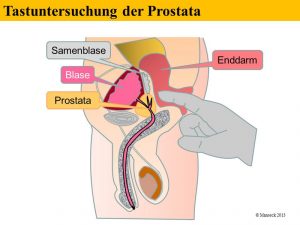 Tastuntersuchung der Prostata