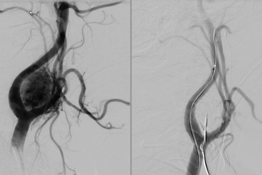 Angiographische Embolisation von gefäßreichen Tumoren der Kopf-Hals Region