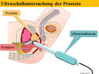 Urologie-Abb-Tastuntersuchung-der-Prostata Ultraschall der Prostata