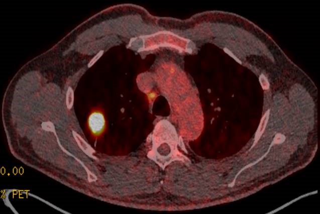 Abb. 1: Nuklearmedizinische Untersuchungsverfahren wie die PET-CT-Diagnostik unterstützen uns bei der Erfassung der Tumorausbreitung und zur Festlegung des Tumorstadiums.