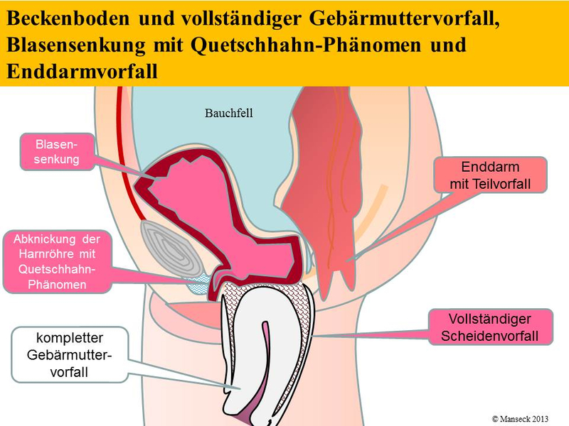 Beckenboden und vollständiger Gebärmuttervorfall, Blasensenkung mit Quetschhahn-Phänomen und Enddarmvorfall