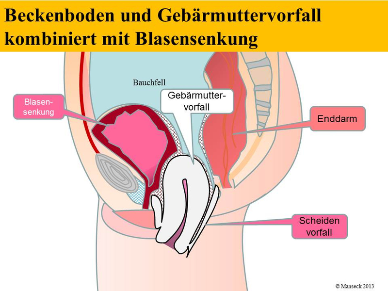 Beckenboden und Gebärmuttervorfall kombiniert mit Blasensenkung