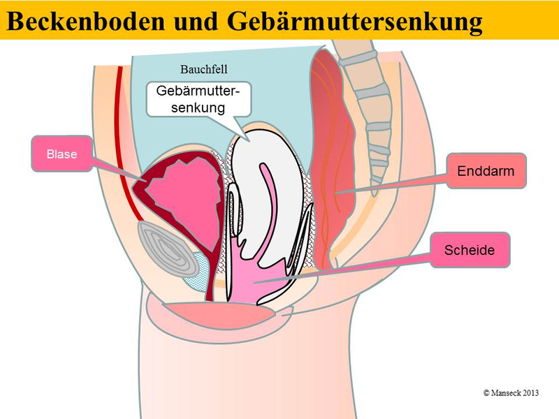 Beckenboden und Gebärmuttersenkung