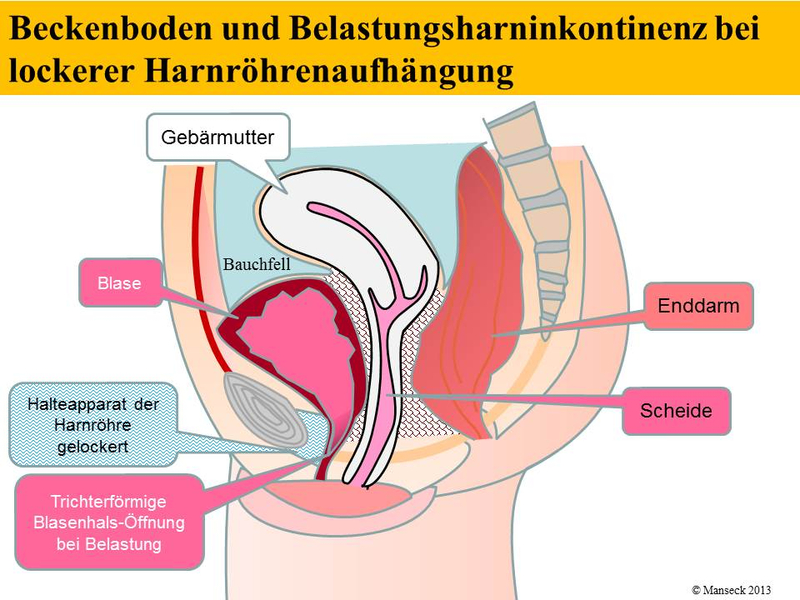 Beckenboden und Belastungsharninkontinenz bei lockerer Harnröhrenaufhängung