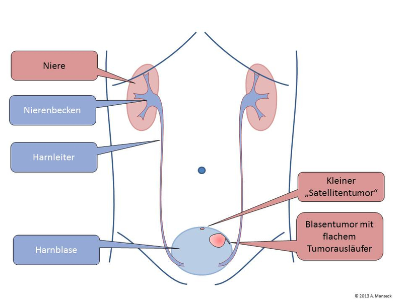 Blasentumor