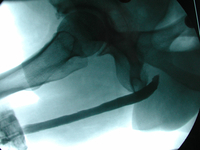 Das retrograde Urethrozystogramm zeigt das Operationsergebnis nach offener Harnröhrenrekonstuktion bei langstreckiger Harnröhrenstriktur