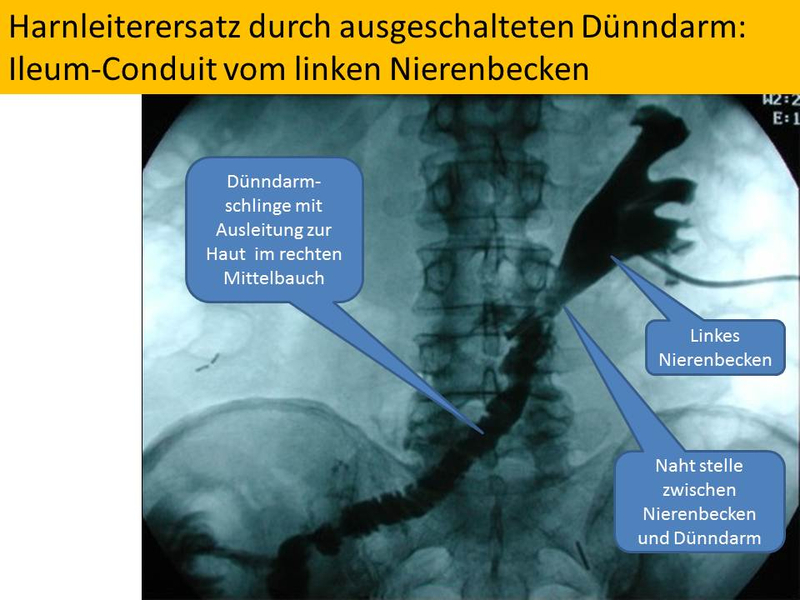 Harnleiterersatz durch ausgeschalteten Dünndarm: Ileum-Conduit vom linken Nierenbecken