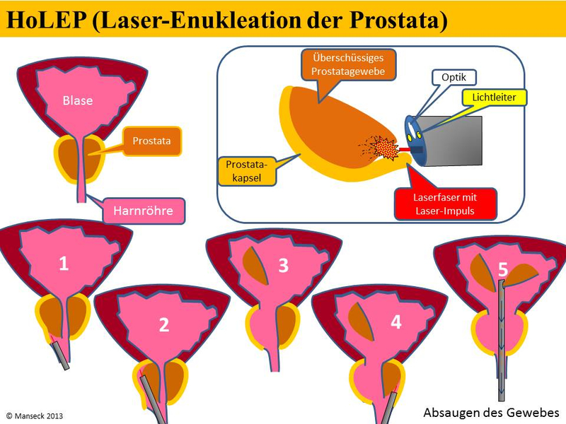 Durchführung der HoLEP