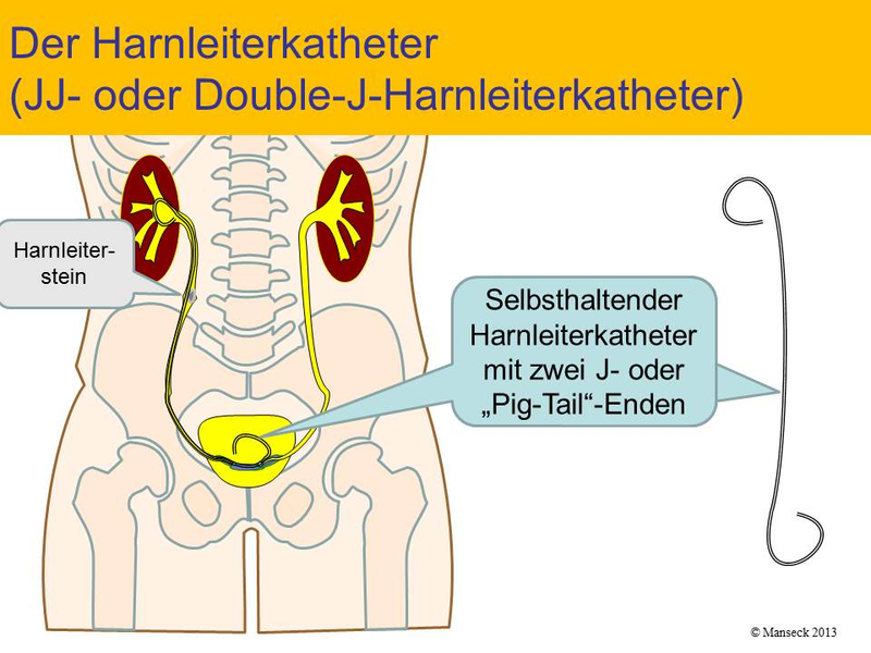 Harnleiterkatheter zur Steinbehandlung