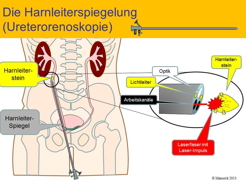 Harnleiterspiegelung zur Steinbehandlung