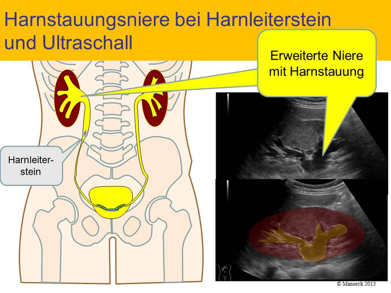 Harnstauungsniere bei Harnleiterstein und Ultraschall