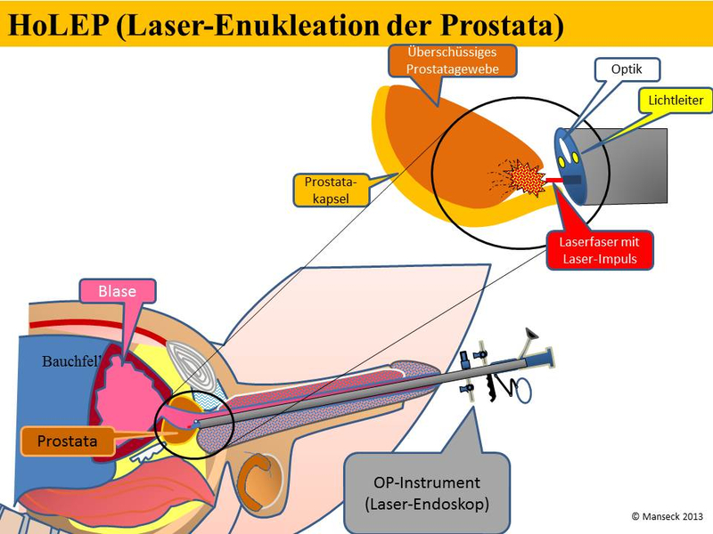 HoLEP (Lase-Enukleation der Prostata)