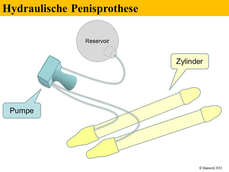 Hydraulische Penisprothese