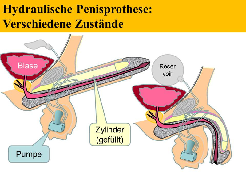 Hydraulische Penisprothese, verschiedene Zustände