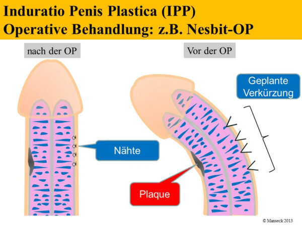 Induration Penis Plastica Ipp Klinikum Ingolstadt 