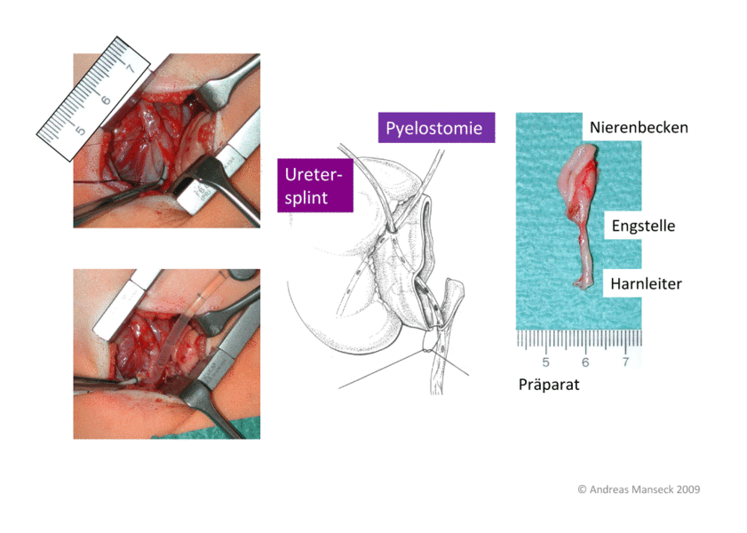 nierenbeckenabgangsenge-op-nach-anderson-heynes-22