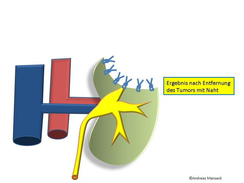 Ergebnis nach Entfernung des Tumors mit Naht