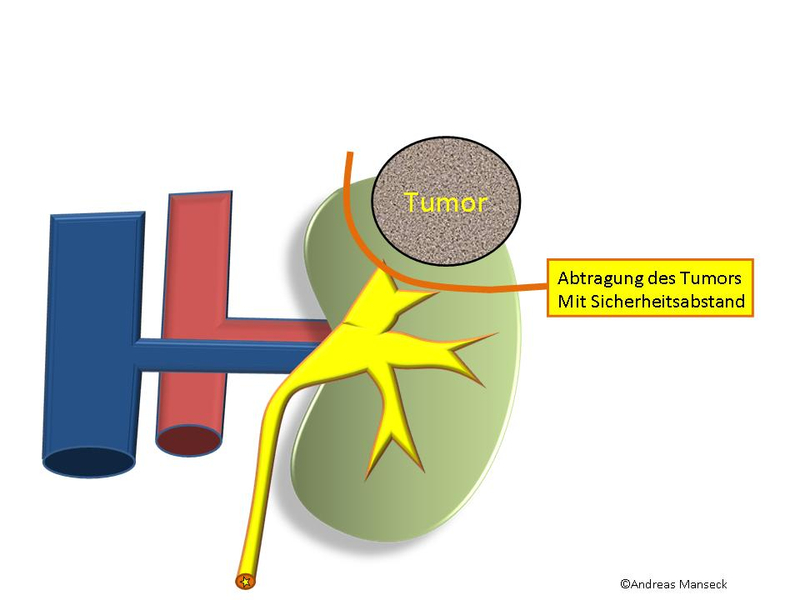 Nierenteilentfernung eines kleinen Nierentumors der linken Niere