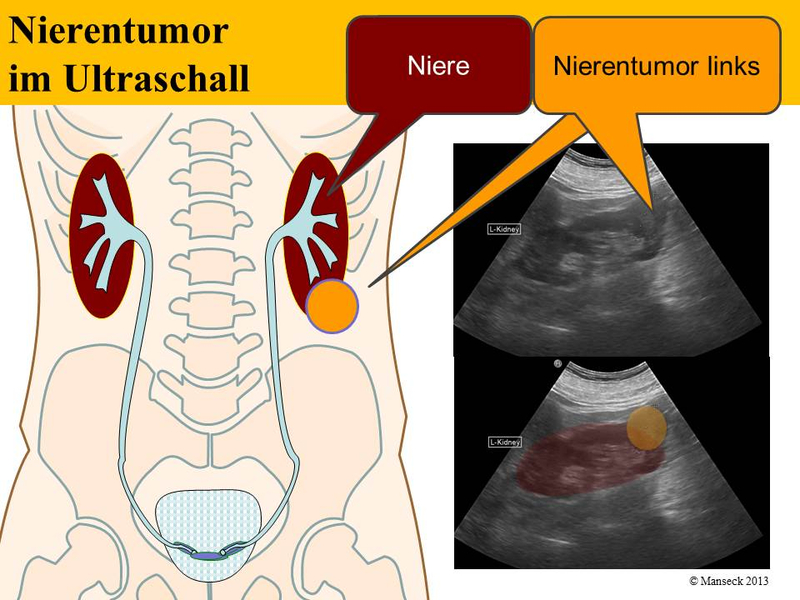 Nierentumor linker Unterpol