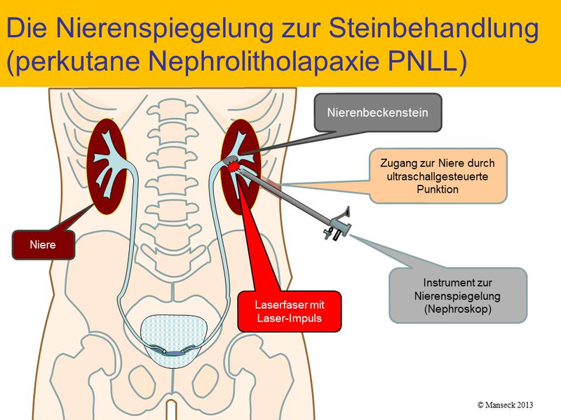 Nierenspiegelung zur Steinbehandlung