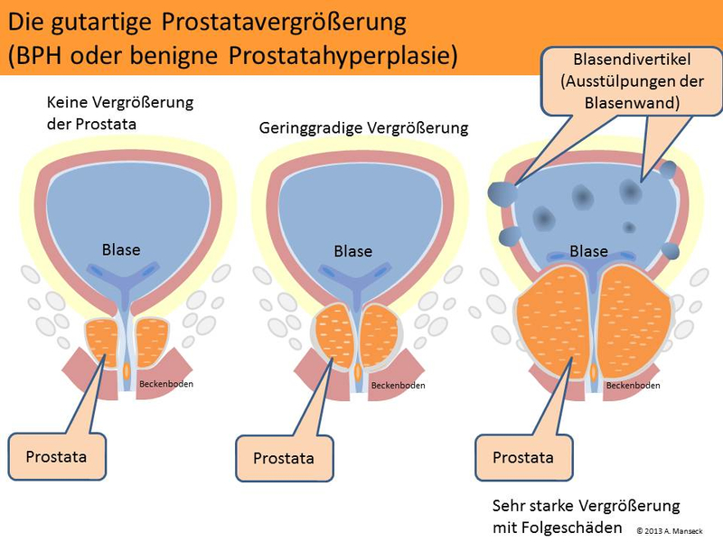 Prostatavergrößerung