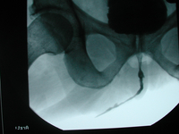 Röntgenbild einer langstreckigen Harnröhrenstriktur vor der Operation