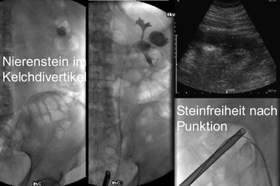 Röntgenaufnahmen von Nierenkelchsteinen