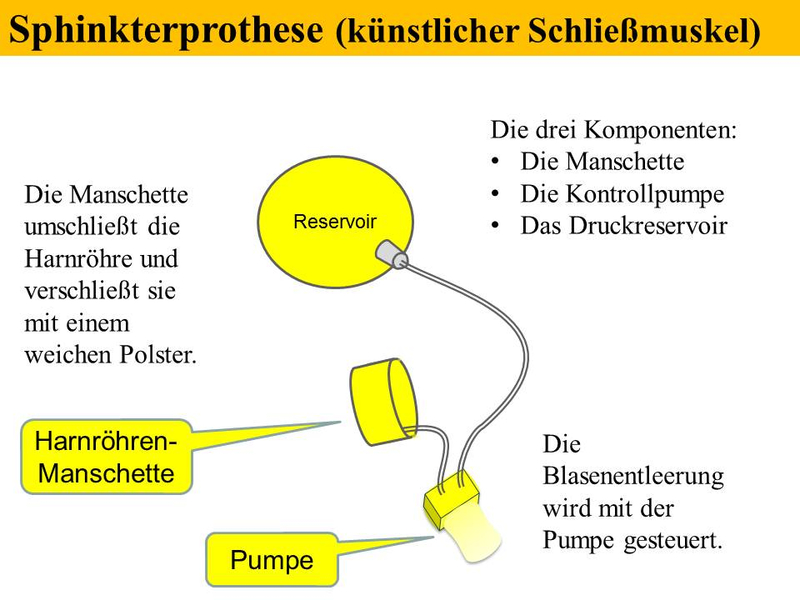 Sphinkterprothese (künstlicher Schließmuskel)