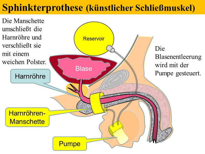 Sphinkterprothese (künstlicher Schließmuskel)