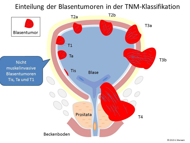 Stadieneinteilung der Blasentumore