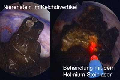 Endoskopische Steinbehandlung mit dem Steinlaser