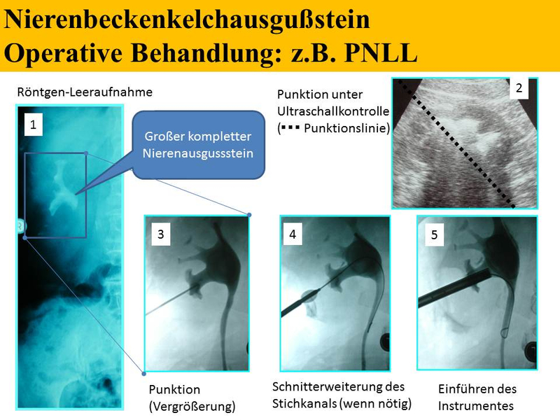 Harnsteinpunktion: wie wird das Operationsinstrument in die Niere eingebracht?