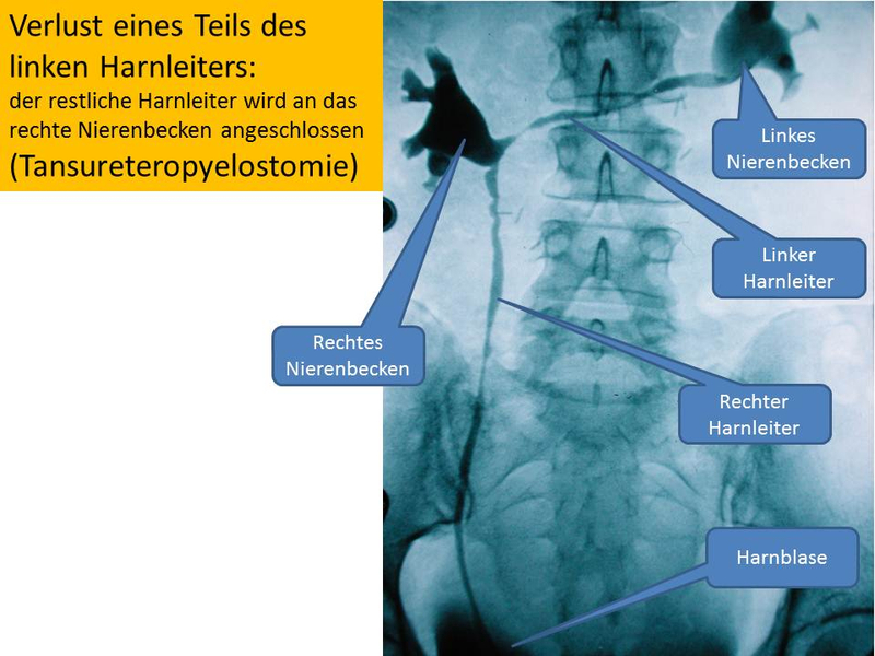 Verlust eines Teils des linken Harnleiters