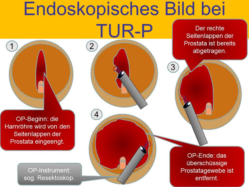 Endoskopisches Bild bei TUR-P