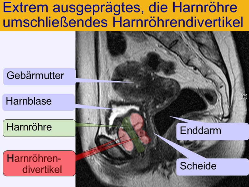 Extrem ausgeprägtes, die Harnröhre umschließendes Harnröhrendivertikel